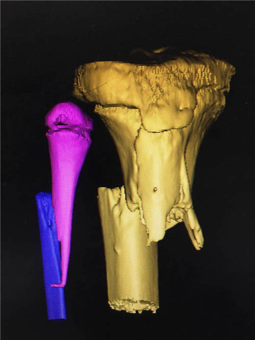 3D技术，北流市人民医院骨科进入“数字化”时代